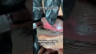 Vitiligo skin disease treatment | Vitiligo coverup tattoo |whitepatch lip permanent treatment |