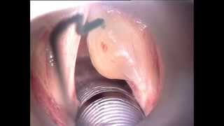 Mucus retention cyst vocal fold    Phonosurgery