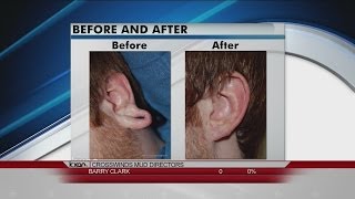 Earlobe Repair