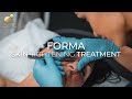 Forma - Skin Tightening Treatment - Yorkshire Skin Centre - Dr Raj Thethi