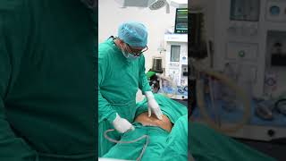 Lower Back Liposuction result #shorts