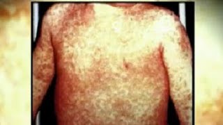 #1 symptom for measles is NOT a rash