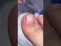 pus under the nail 😮 ingrown toenail