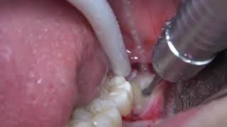 Extraction of lower impacted third molar wisdom tooth. DR PRABHURAJ SABARAD