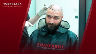 Live Hair Transplant Operation at Turkeyana Clinic