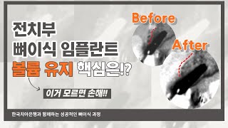 [한국치아은행] 121. 전치부 'Esthetic zone' 뼈이식 임플란트의 효과적인 볼륨 유지 방법은?＿뼈이식 치유 과정과 효과_엄인웅 박사