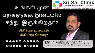 சந்து பற்களால் சங்கடமா சரி செய்யும் முறைகளும் அதற்கான செலவும் - Gap between front teeth