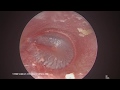 Module 01: Introduction to Endoscopic Ear Surgery (EES)