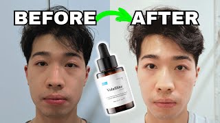 I used Volufiline for 150 Days on my Dark Circles | Does it WORK?