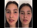 Facial Paralysis & Bell’s Palsy Reconstruction