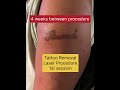 Tattoo Removal is Expensive and Time Consuming!