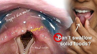Cricopharyngeal Dysfunction: Difficulty Swallowing, Especially Solid Foods