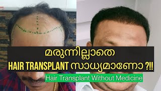 Hair Transplant without Minoxidil Finasteride || ഹെയർ ട്രാൻസ്‌പ്ലാന്റ് മരുന്നില്ലാതെ success ആവുമോ ?