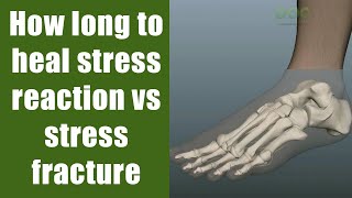 How long to heal stress reaction vs stress fracture in a runner