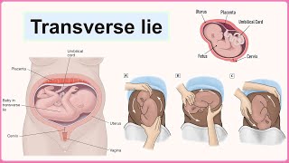 transverse lie