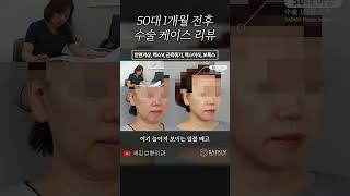 50대 이중턱 맥스브이, 안면거상, 근육묶기, 맥스이식, 보톡스 수술 1개월 전후 수술 케이스 리뷰 #shorts #이중턱 #안면거상