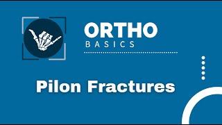 Ortho Basics: Tibial Plafond/Pilon Fractures