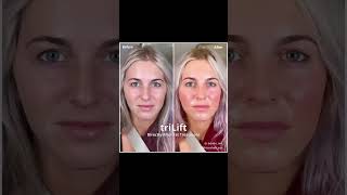 triLift transformation from Dr. John of The Garden Medical Spa