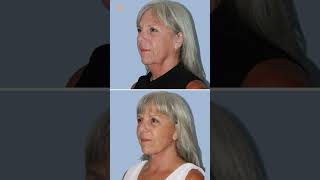 Amazing Facial Rejuvenation Results #antiaging #cosmetic #plasticsurgeon #beforeandafter #smas