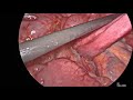 laparoscopic lysis of adhesion for chronic small bowel obstruction 2x