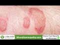 தடிப்புத் தோல் அழற்சிக்கு சிறந்த சிகிச்சை best treatment for psoriasis patients in tamil