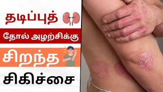 தடிப்புத் தோல் அழற்சிக்கு சிறந்த சிகிச்சை | Best Treatment For Psoriasis Patients in Tamil