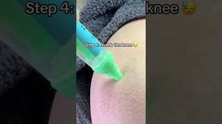 Knee Surgery Tomorrow #asmr #asmrvideos #satisfying