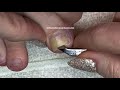👣How to Pedicure Stage 3 Ingrown Big Toe with Granulation Tissue👣