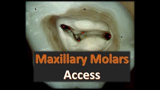 Maxillary Molars Access -- Endodontics from A to Z(3)