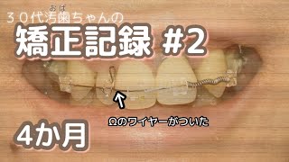 【30代矯正記録#2】歯列矯正4か月目