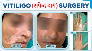 Vitiligo (सफ़ेद दाग ) Surgery | Safed Daag का इलाज | सफेद दाग का इलाज | Safed Daag | Kayakalp Global