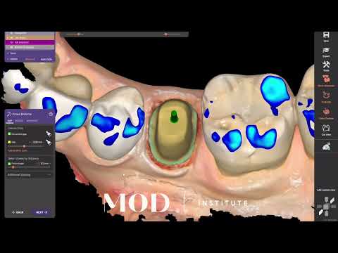 Shining Elite Exocad Midas The Most Powerful Same Day Workfloe Youtube