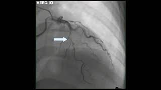 The Young Heart Tears Easily Apart: A Case Report of Spontaneous Coronary Artery Dissection