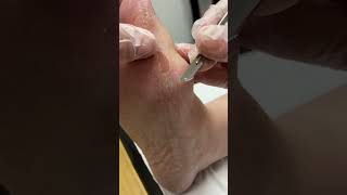 Ultimate Callus Removal by Australian Podiatrist | Dry Skin Solutions | Ergonx | Docpods