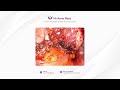 robotic myomectomy removal of fibroids