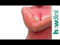 Quick sunburn relief - Sunburn treatment and remedies