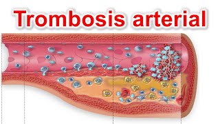 Trombosis arterial (con énfasis en el síndrome coronario agudo y la enfermedad cerebrovascular)