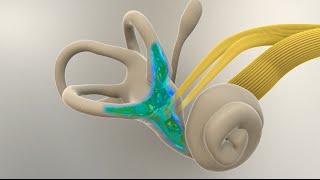 Meniere's Disease - What Happens in the Inner Ear?