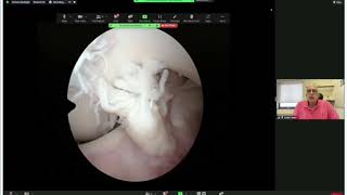 ACL Reconstruction: How I do it : Dr Anant Joshi