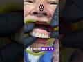 THE  BEST DENTURE #misterdent #viral