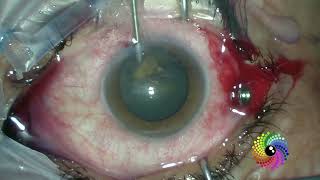 20211224 3 Sil Filled Eye+Rec RD+Comp Cat OS Phaco+Fold +17, Eye Cryl+Sil Rem+Reinj