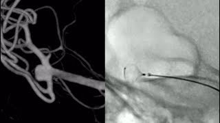 (English) Artisse implantation (intrasaccular flow disruptor) for an MCA aneurysm