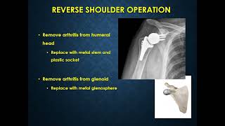 Total Shoulder Arthroplasty and Reverse Shoulder Arthroplasty Patient Education