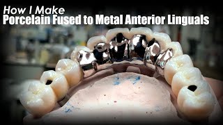 Step-By-Step: Porcelain Fused to Metal Anterior Linguals