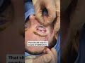 Plastic Surgeon Demonstrates Canthopexy Lid Snap Test