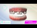 brackets 3d ortodoncia con ausencia dental ortosonrisas barranco