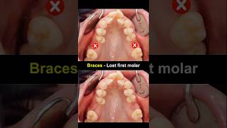 Braces wheb lost first molar teeth #braces #orthodontist #dentist