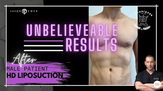 AFTER Male 360 HD Lipo: UNBELIEVABLE Body Sculpting Results!