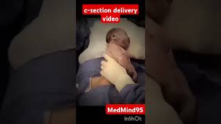 c-section delivery video ll cesarean section delivery ll #cesareanbirth #delivery #video #doctor #mp