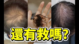 【防脫秘籍】出現脂溢性脫髮怎麼辦丨脂溢性脫髮的2种情況丨脂溢性脫髮的治療方式丨植髮醫生徐魯